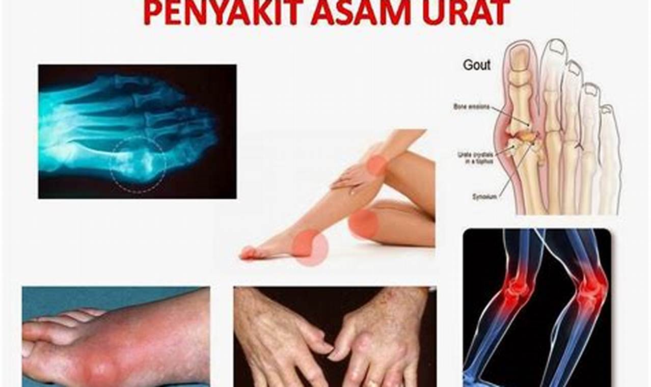 Cara Mengatasi Asam Urat Cara Mengatasi Asam Urat